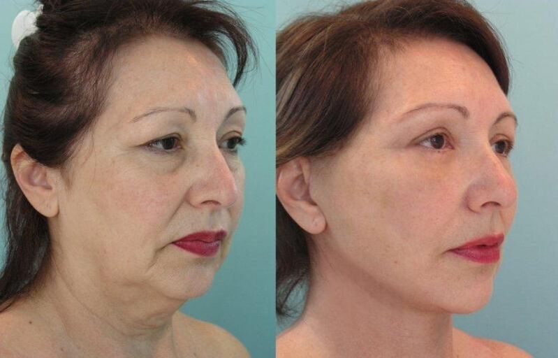 The result of facial skin tightening rejuvenated with threads