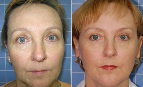 Fractional laser before and after facial rejuvenation