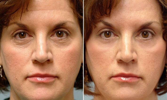 face before and after laser fraction rejuvenation