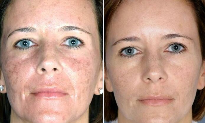 photo before and after fraction laser rejuvenation
